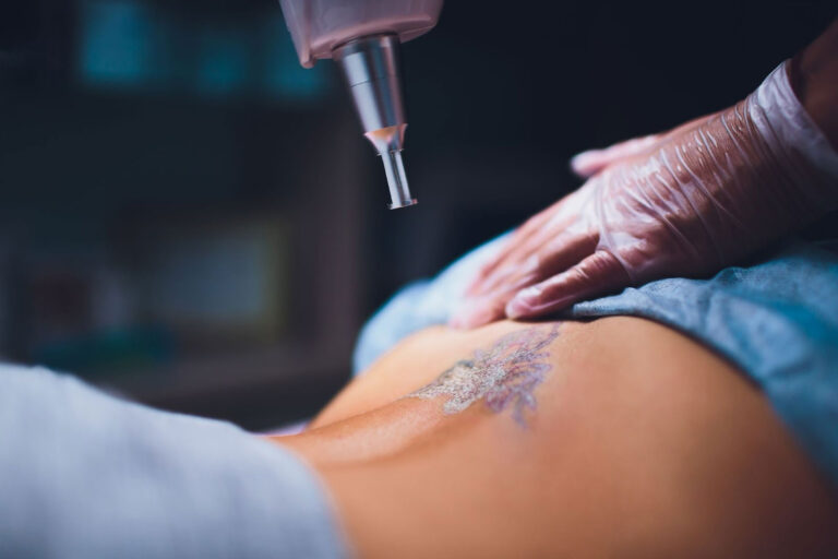Laser handpiece held above a tattoo on a person's lower back