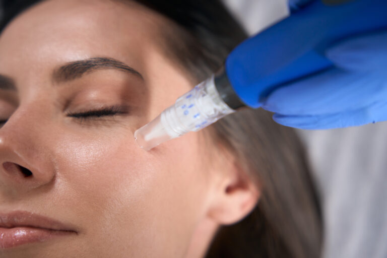 Gloved hand holding a microneedling pen against a woman's cheek