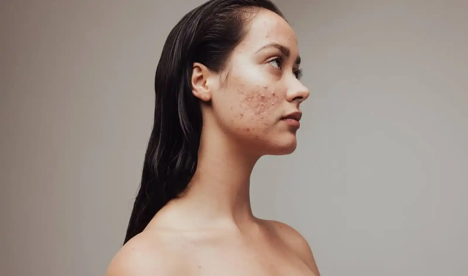 Acne: Side-profile portrait of a woman with visible facial acne and blemishes.