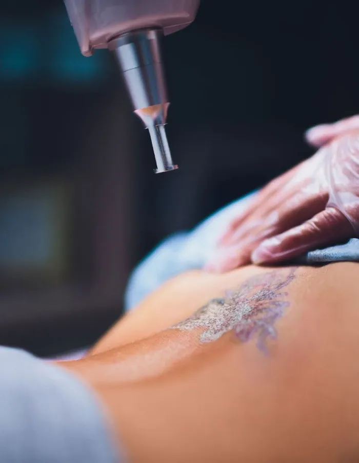 Laser treatment being performed on a tattooed area of skin